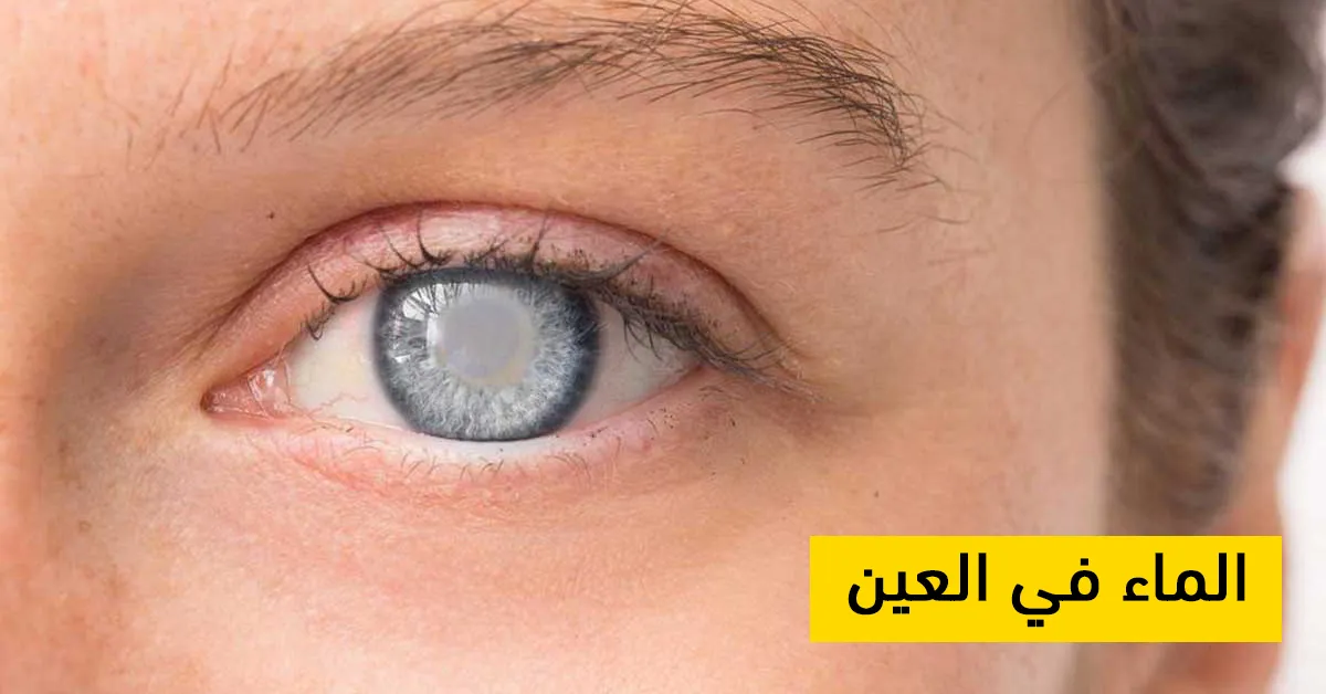 الماء في العين